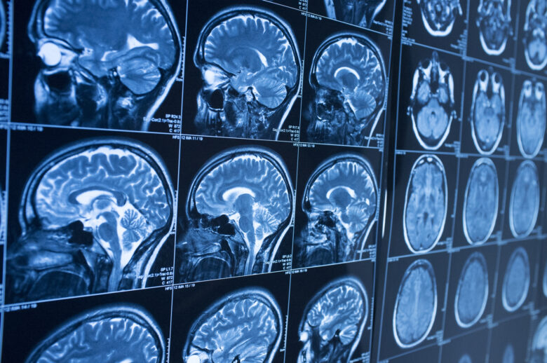 4 Types of Brain Injuries and 3 Levels of Severity