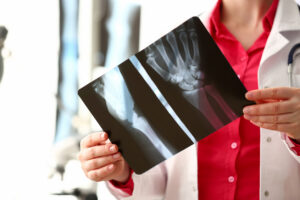 Types of Broken Bones
