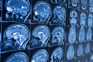 What Causes Traumatic Brain Injuries In Austin, Texas?